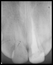 Fig 12 : Contrôle radiographique à 1an.