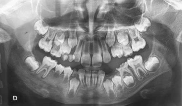 Examen radiologique montrant une ostéo-condensation au niveau du secteur prémoléro-molaire mandibulaire droit.
