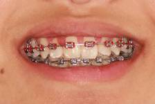 Traitement orthodontique positif