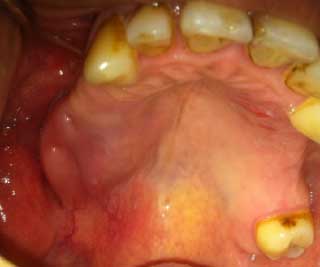 Examen endobuccal: La présence d’une tuméfaction palatine droite.