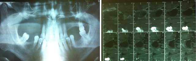 Examen radiologique, 3a. panoramique, 3b. cône beam : lyse osseuse au niveau du secteur maxillaire droit associée à une effraction et un comblement sinusien droit.