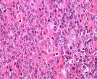 Examen anatomopathologique: Les cellules lymphomateuses Type B ayant une grande taille et un noyau avec une chromatine claire contenant un ou plusieurs nucléoles ; de nombreuses mitoses sont visibles.