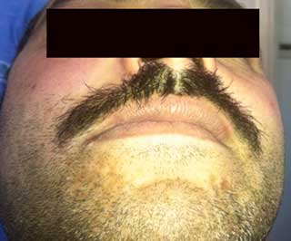 Examen exobuccal: Asymétrie faciale et palpation douloureuse.