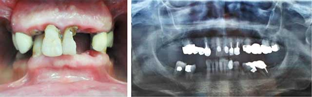Fig 1 : Vue Endobuccale avant traitement. Fig 2 : Radiographie panoramique.
