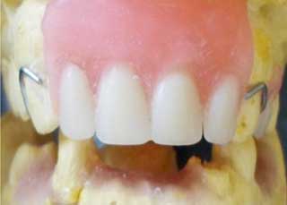 Fig 10 : Montage des dents sur cire.