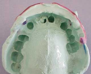 Empreinte à l’alginate.
