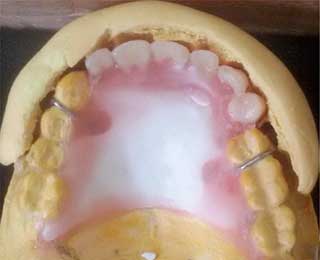 Fig 7 : Clé vestibulaire guidant le montage des dents.