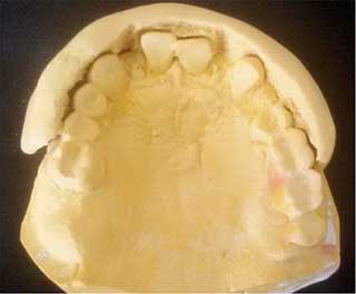 Fig 6 : Clé vestibulaire en silicone de haute viscosité.