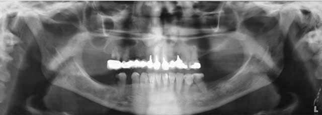 Fig 2 : Radiographie panoramique