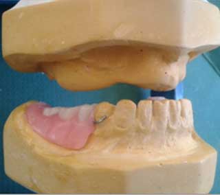 Fig 8 : Aspect du modèle maxillaire après correction