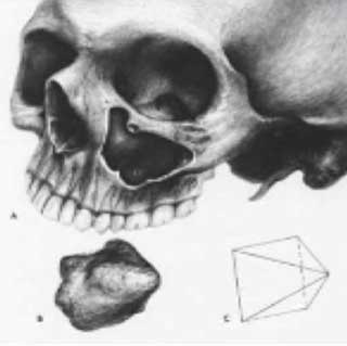 Fig 1 : La forme pyramidale du sinus maxillaire (8).