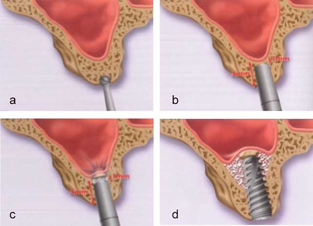 Fig 14 : Les étapes de la technique de l’ostéotome décrite par Summers :  a- Fraisage de la corticale à l’aide d’une fraise boule. b- Préparation du site implantaire  à l’aide des ostéotomes. c- Fracture de la corticale du plancher sinusien à l’aide de l’ostéotome (un biomatériau peut être interposé entre l’ostéotome et la corticale). d-introduction du biomatériau dans l’espace nouvellement formé avec la pose d’un implant d’une hauteur satisfaisante (24).