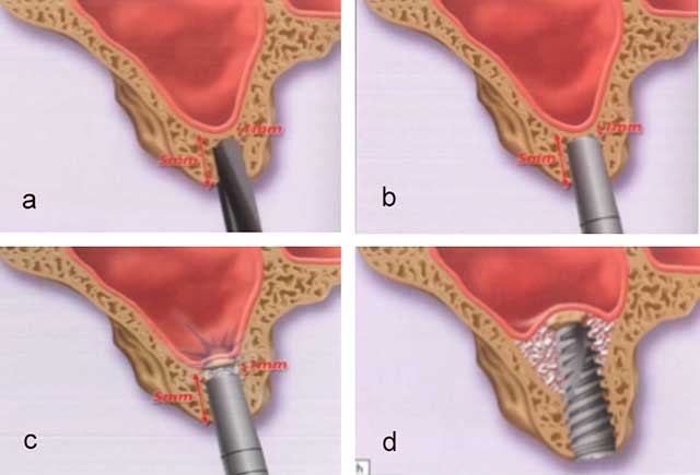 Fig 15: Les étapes de la technique de l’’ostéotome modifié par Lazzara (1996):          a- passage des  forets jusqu’à une distance de 1 à 2 mm du plancher sinusien. b- Préparation du  site implantaire  par des ostéotomes (n°2 et 3). C- Fracture du plancher sinusien après interposition de matériau de comblement. d- Mise en place immédiate de l’implant dans le site augmenté (24).