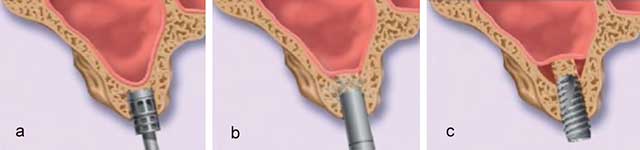 Fig 16 : Les étapes de la technique de l’ostéotome de Fugazzotto. a- Passage du trépan millimétré jusqu’à une distance de 1mm du plancher sinusien. b- Passage de l’ostéotome n°4 et fracture du plancher sinusien. c- Le cylindre osseux est poussé apicalement par l’implant (24).