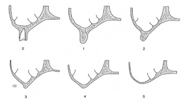 Fig 4 : Différents stades de résorption osseuse maxillaire en coupe frontale après édentation selon Fallschüssel.