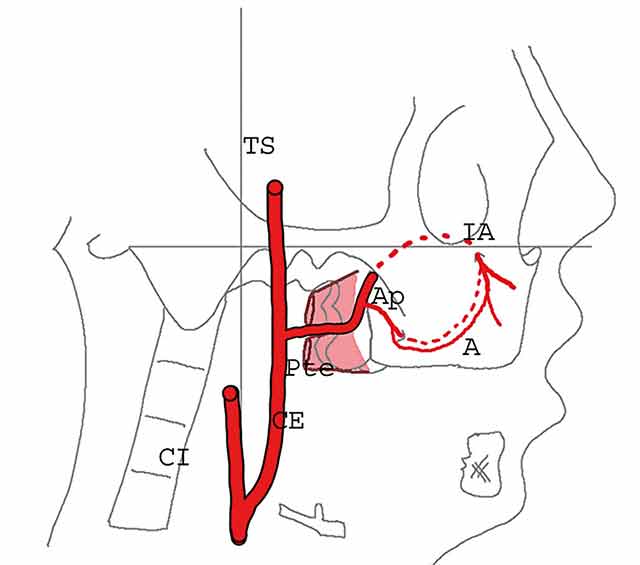 Fig 5 : La carotide externe (CE) donne ses deux branches terminales : temporale superficielle (TS) et maxillaire qui passe entre les deux faisceaux du muscle ptérygoïdien latéral (Pte). Il existe deux boucles anastomotiques (A), l’une périostée et l’autre intra-osseuse (en pointillés) entre l’artère alvéolaire postérieure et supérieure (Ap) et l’artère infra-orbitaire (IA).