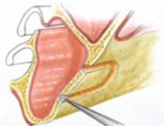  Fig 9 : Ostéotomie avec une fraise boule (Vue de face) (20).