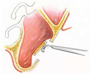 Fig 10 : Le déplacement du volet osseux (20).