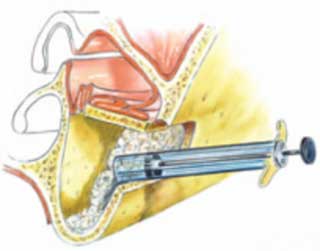 Fig 12 : L'apport du matériau de comblement (20).