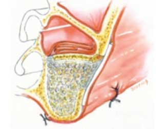 Fig 13 : Le placement de la membrane avec repositionnement du lambeau et les sutures (20).