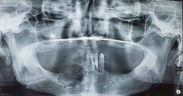 Fig 3 : Radiographie panoramique montrant une image radioclaire multi-géodique.