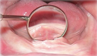 Fig3: Hyperplasies fibreuses inflammatoires.