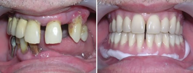 Fig7: Cas de prothèse immédiate complète.