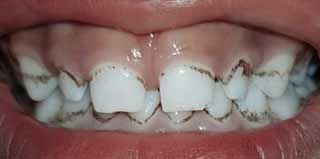 Taches noires extrinsèques de degré 1 au niveau de la 51- 52 et de degré 2 sur les autres dents selon la classification de Gasparetto et coll. Service de Pédodontie-Prévention, CCTD-Rabat, Maroc.