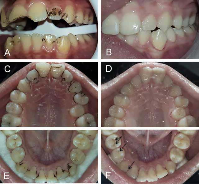 Fig.3A-F : Vues de côté, maxillaire et mandibulaire des dents chez un enfant présentant des colorations noires exogènes avant et après polissage.