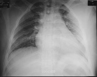 Fig.5 : Radiographie du thorax.