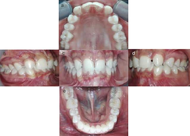 Remplacement des incisives antérieures maxillaires de 12 à 21