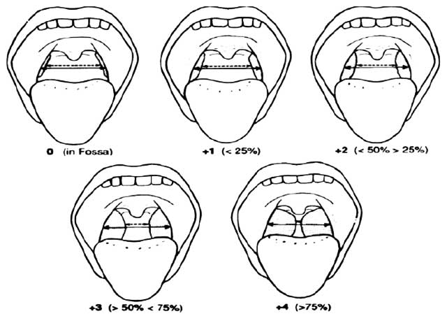 Particularité céphalométrique des enfants ou jeunes patients avec hypertrophie des tonsilles palatines