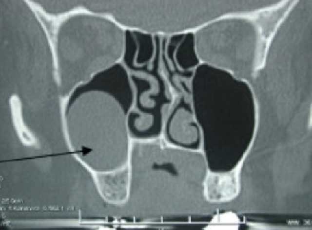 TDM du massif facial en coupe coronale :  montrant la présence d’un polype dans le sinus maxillaire droit.