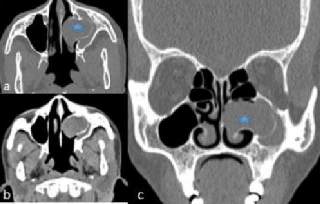 TDM du massif facial en coupes axiale et coronale Etoile en bleu montre la mucocèle du sinus maxillaire gauche hypodense par rapport aux muscles avec amincissement des parois osseuses entrainant une obstruction de la fosse nasale gauche.