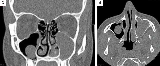 kyste muqueux du sinus maxillaire droit et comblement du sinus maxillaire gauche. Patiente présentant une symptomatologie de sinusite maxillaire aiguë gauche récidivante. Image rétentionnelle sur l’IRM. Diagnostic per-opératoire : kyste muqueux maxillaire gauche surinfecté.