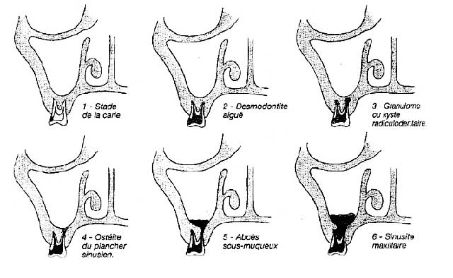 Étapes de la sinusite dentaire d’après TERRACOL.