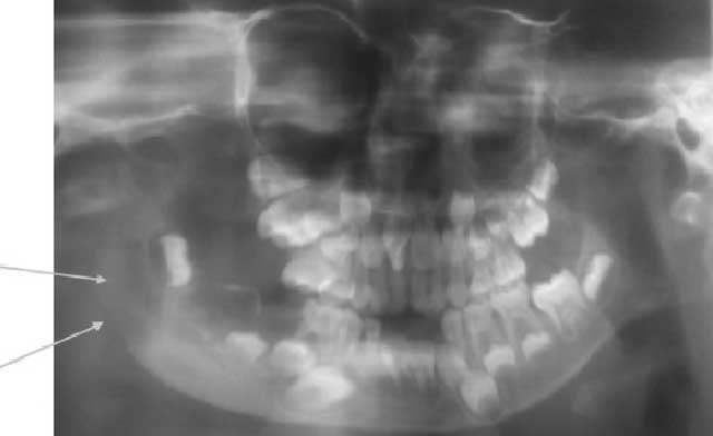 Radiographie panoramique dentaire montrant une fracture de la branche montante de la mandibule droite avec ostéolyse.