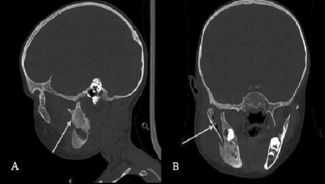 TDM faciale en reconstruction sagittale (A) et coronale (B) montrant une ostéolyse et une fracture verticale de la branche montante droite de la mandibule.