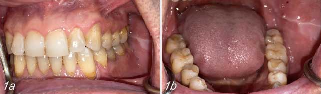 Examen clinique endobuccal ne montrant aucune particularité.