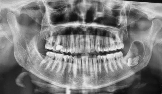 Radiographie panoramique prise le 06/02/2020.