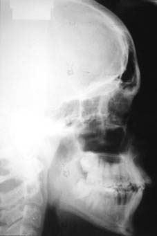 Fig.10 :  téléradiographie de profil avant traitement