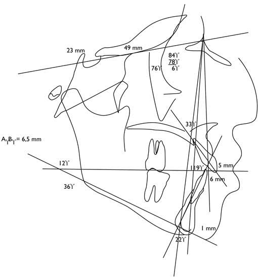 Figure 11 : tracé céphalométrique avant traitement