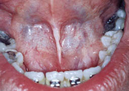 Fig.12 : photo montrant le résultat de la frénectomie linguale 15 jours après la cicatrisation