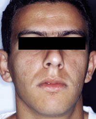 Fig.15 :  photos exobuccale de fin de traitement (face)