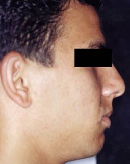 Fig.16 :  photo exobuccale de fin de traitement (profile)