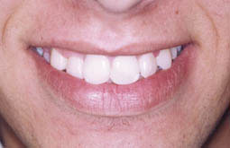Fig.17 :  sourire de fin de traitement