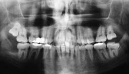 Fig.21 : radiographie panoramique de fin de traitement 
