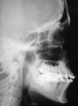Fig.22 : téléradiographie de profil de fin de traitement juste avant la dépose de l’appareillage orthodontique