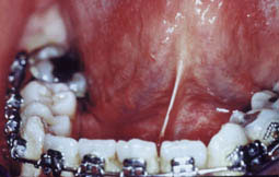Fig.7 :  photo montrant la brièveté du frein lingual avant sa résection