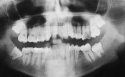 Fig.8 : radiographie panoramique avant traitement